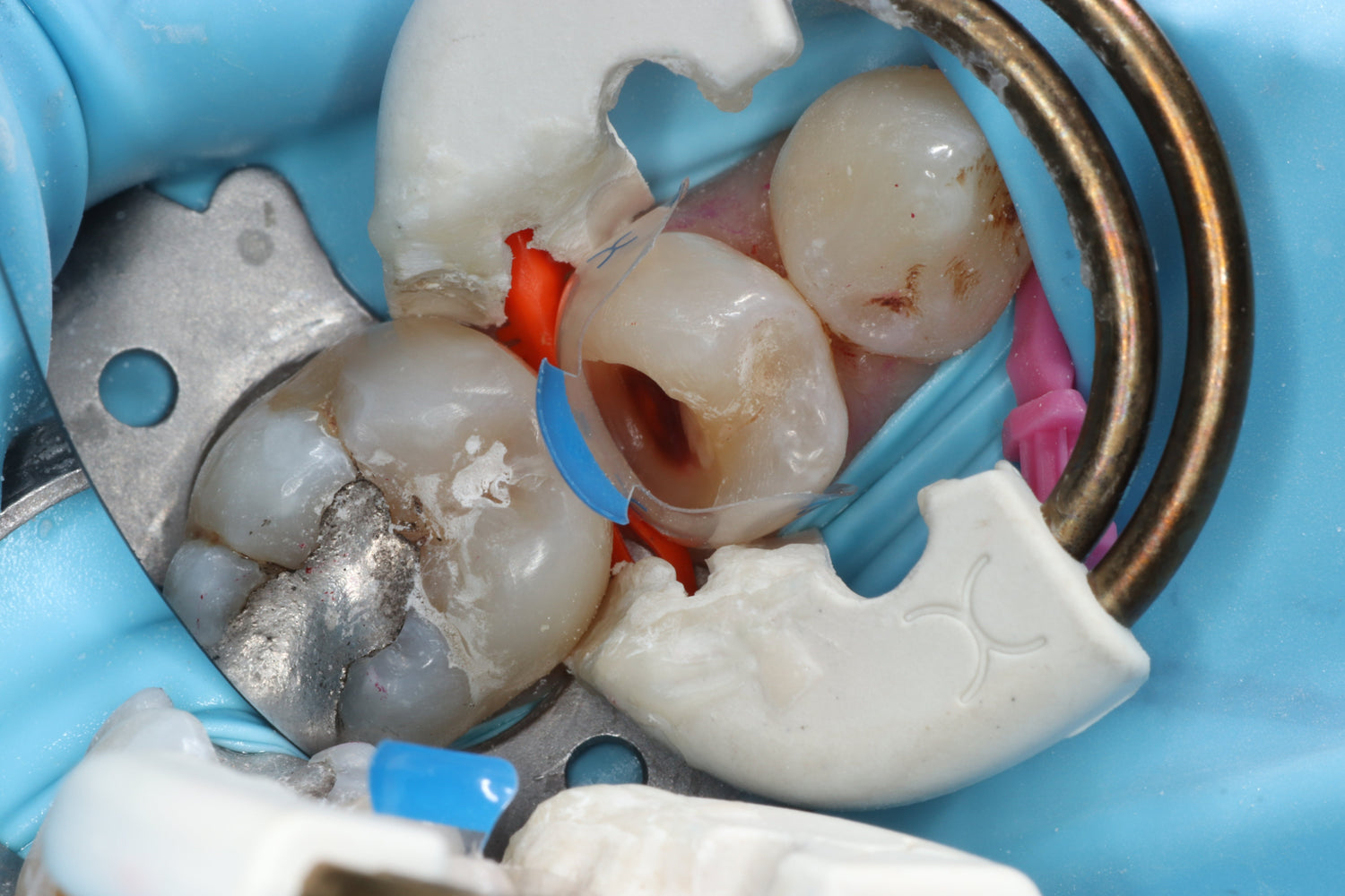 matrix and ring on molar premolar